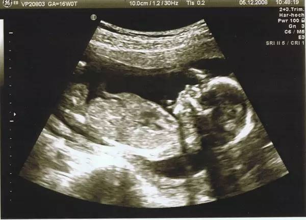 怀孕16周男孩b超图片图片