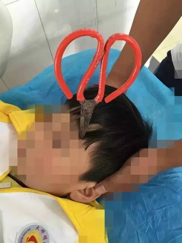 孩子被剪刀扎伤的图片图片