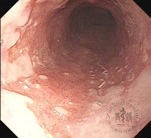 食管乳头状增生图片