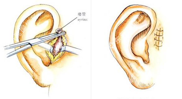 耳前瘘管手术3d图解图片