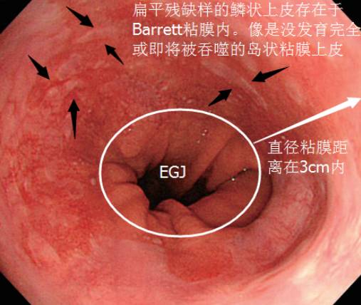 典型巴雷特食管图片图片