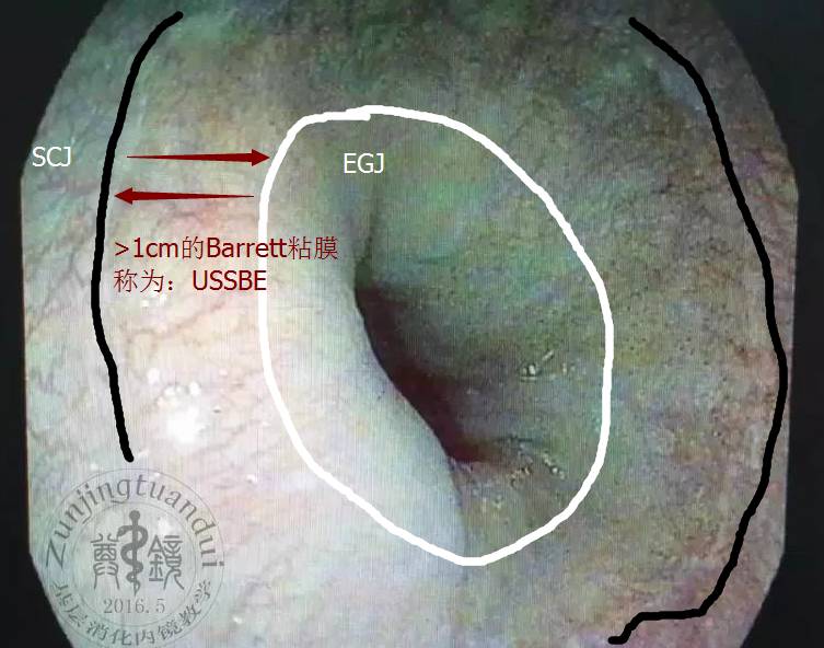 巴雷特食管全周型图片