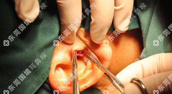 耳前瘘管手术过程图片