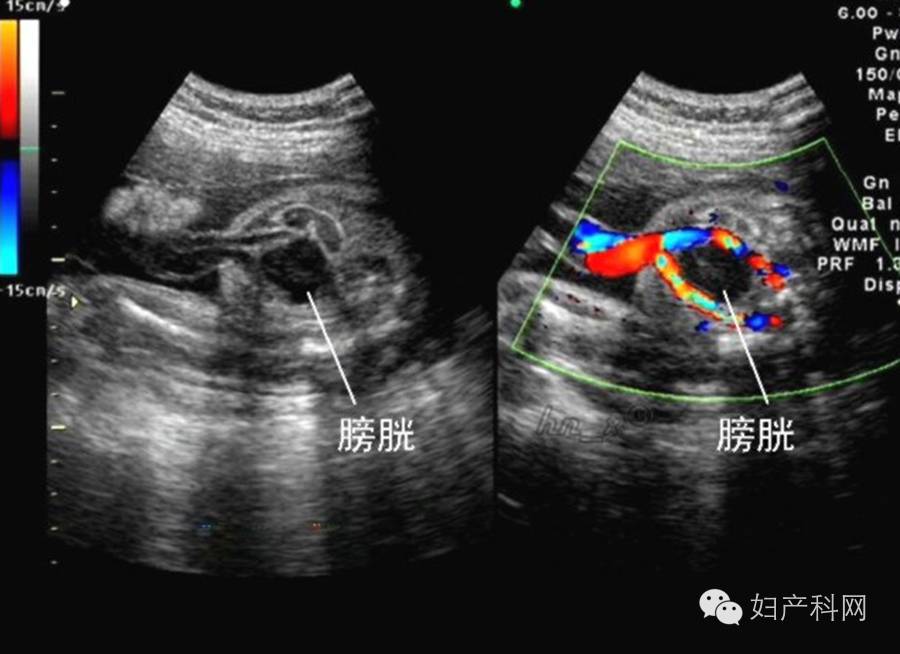 胎儿脐带彩超图片