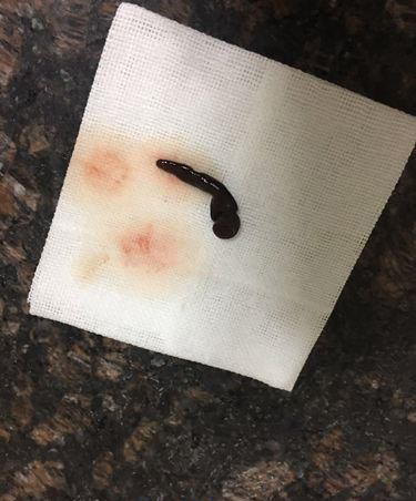 男子鼻腔频繁出血就诊取出5厘米长蚂蝗
