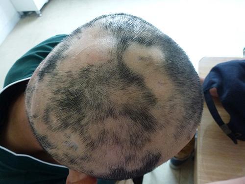 斑秃属于燥脱,是脱发现象中较为严重的一种