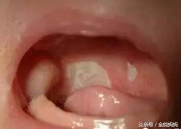 婴儿上颚口腔溃疡图片图片