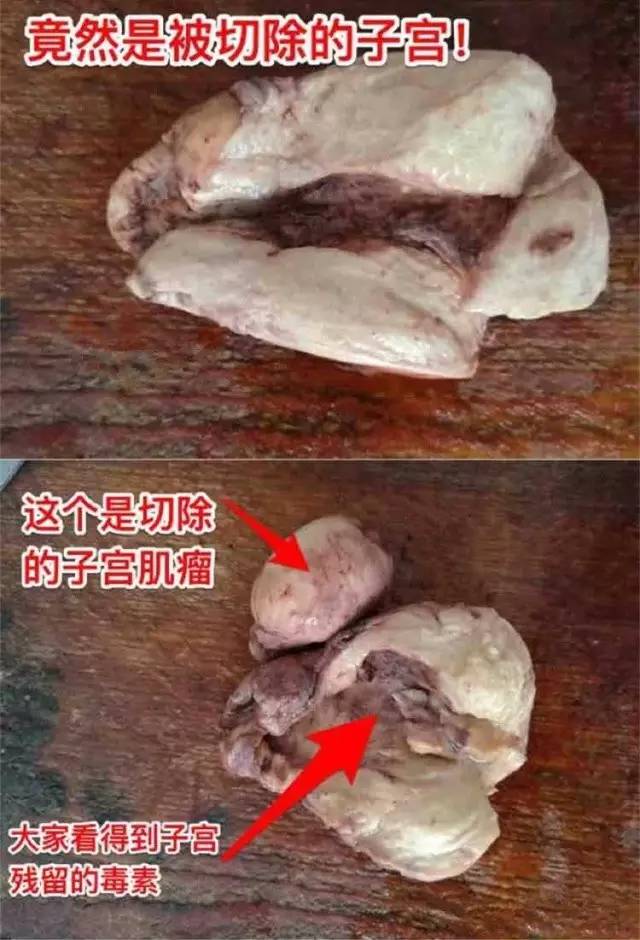 95%的子宫肌瘤都是从痛经