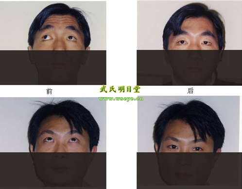 治疗近视眼的偏方_近视眼治疗偏方秘方大全_近视眼治疗偏方大全