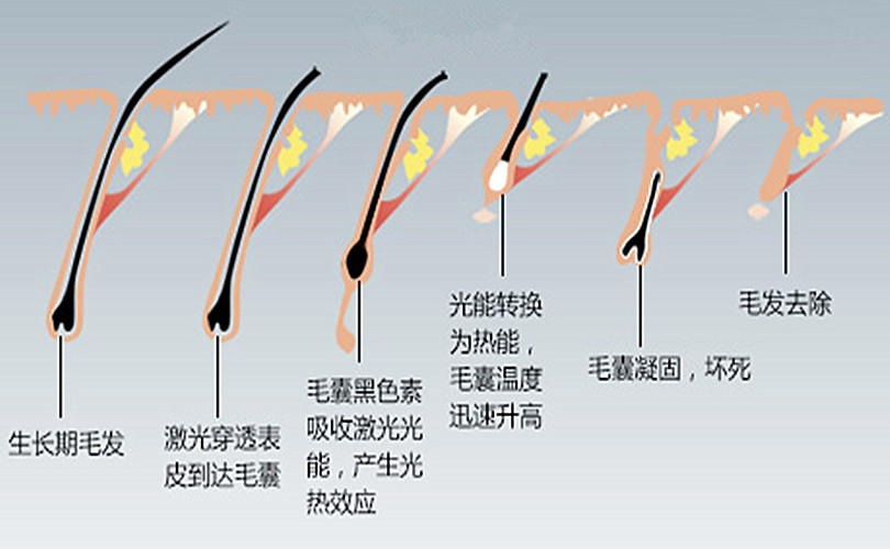 激光脱毛原理图片