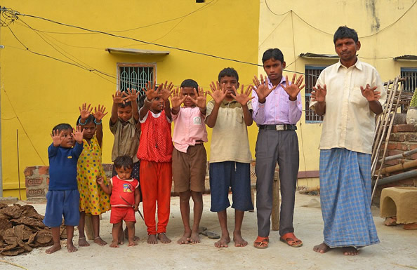 位于印度比哈尔的一个家族,家中25名成员都有12根手指和12根脚趾,全家