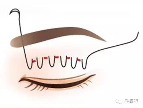 4个步骤详解埋线双眼皮手术全过程 内附图片详情