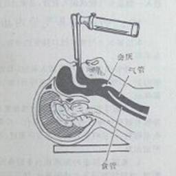 气管插管解剖示意图图片