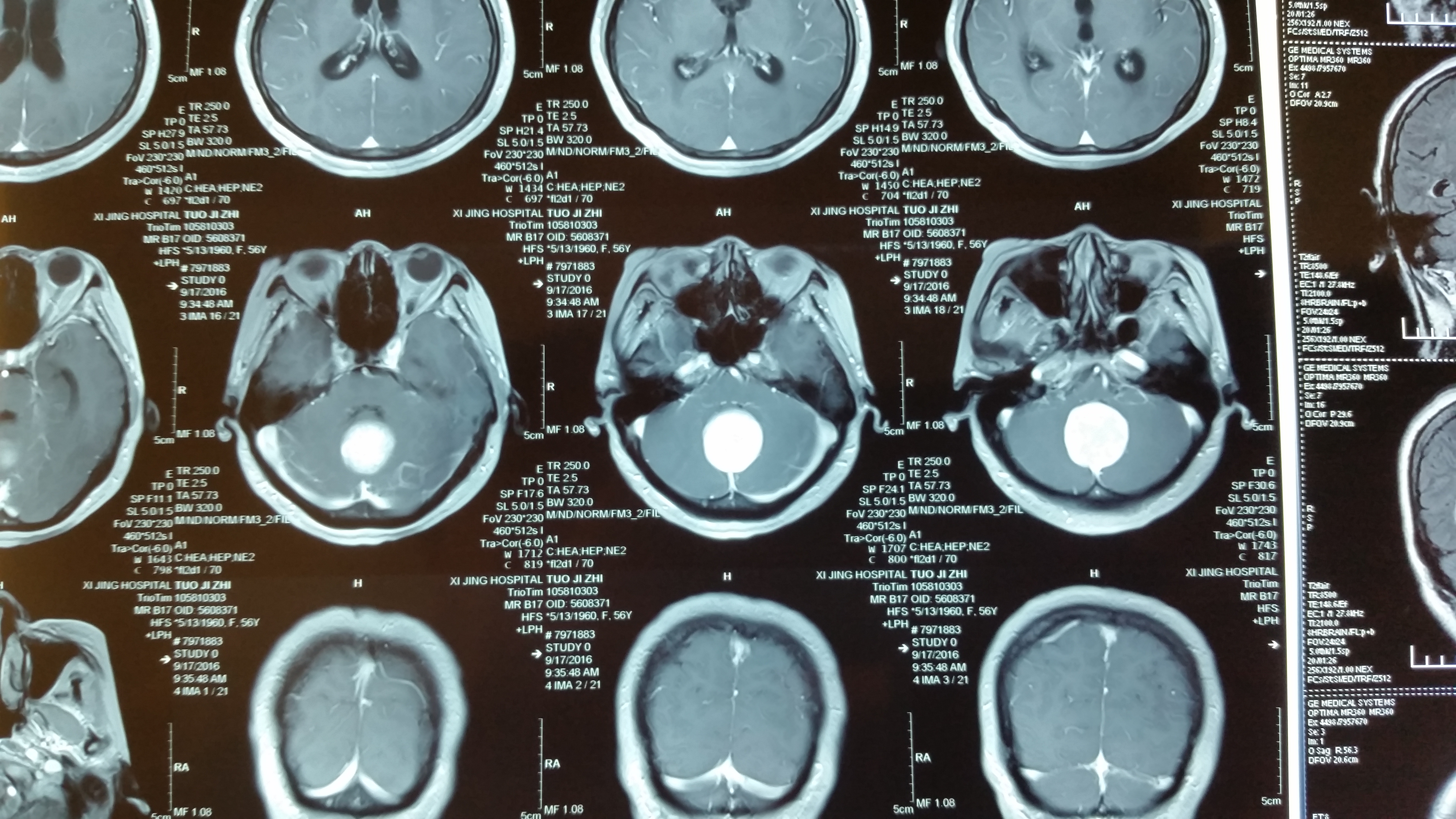 賀曉生教授:幕下小腦鐮旁雙側腦膜瘤的手術切除