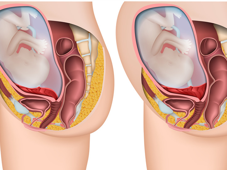 胎盘位置 宫底图片