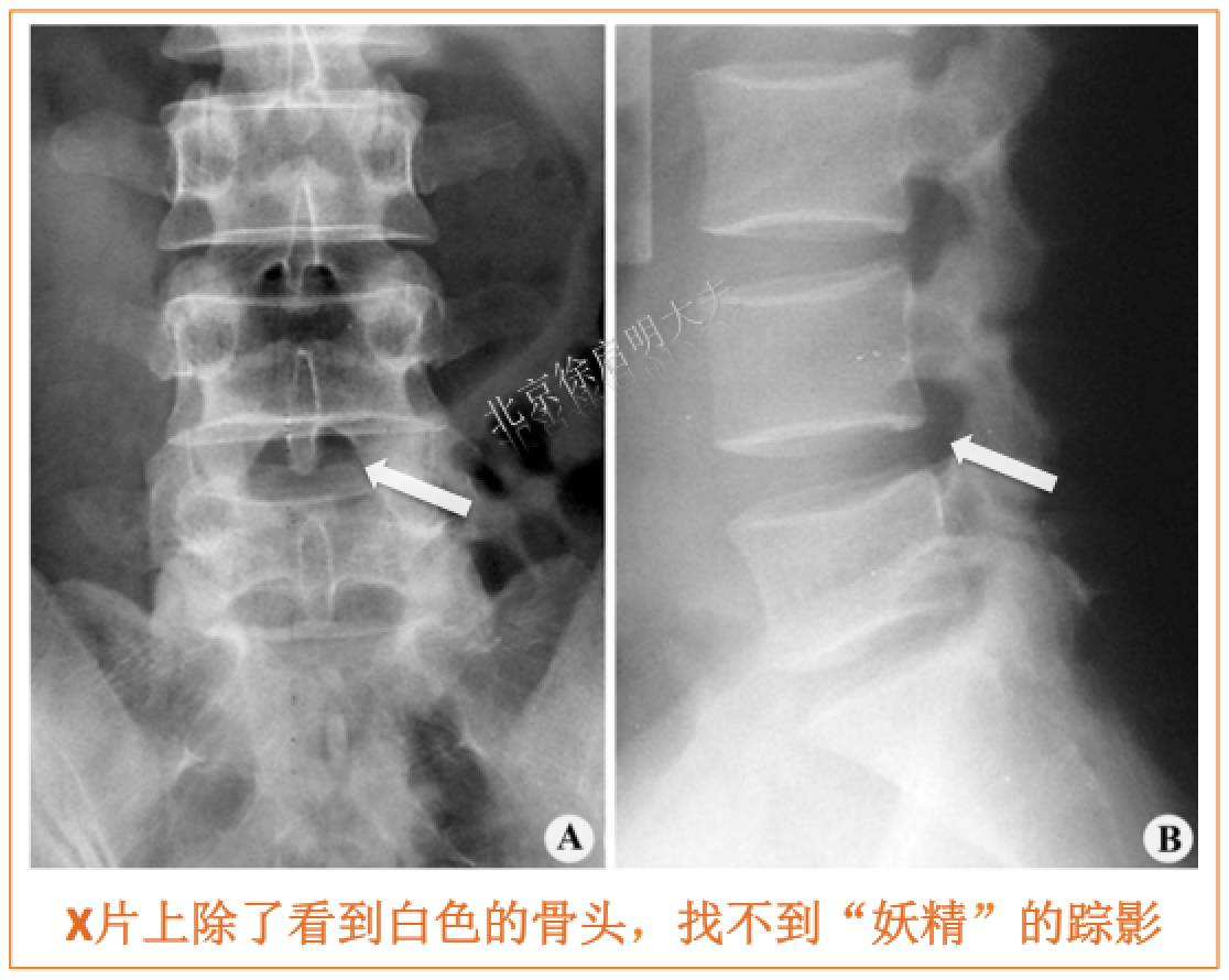 北京協和醫院博士寫了篇小說,竟把椎間盤突出講透徹,看完腦洞大開