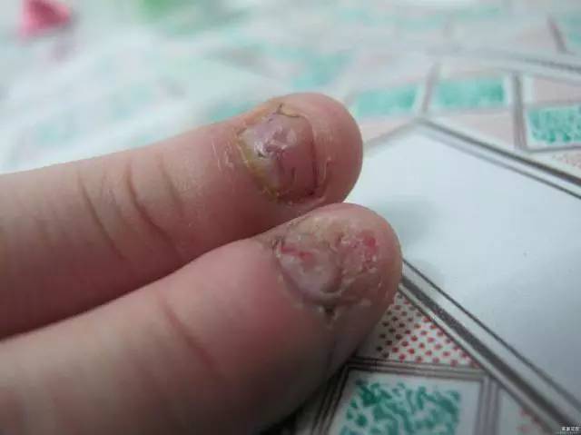 长期啃指甲的危害图片