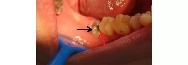 阻生牙:以智齿最为常见,如反复发炎或导致邻牙发生蛀牙等,需要尽早