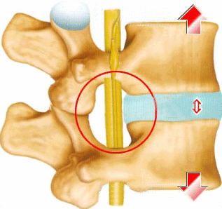 腰椎间盘突出与骨质增生之间的区别与联系