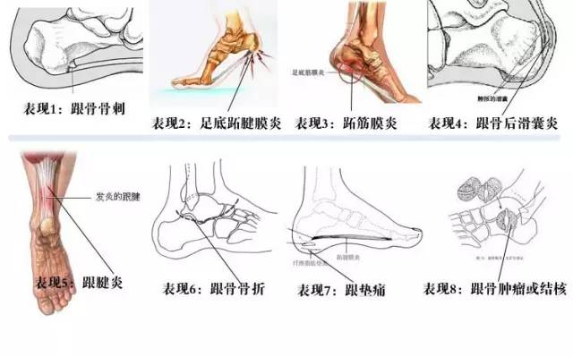 但足跟的骨质,关节,滑囊,筋膜等处,这种病从外表看不出任何症状,其与