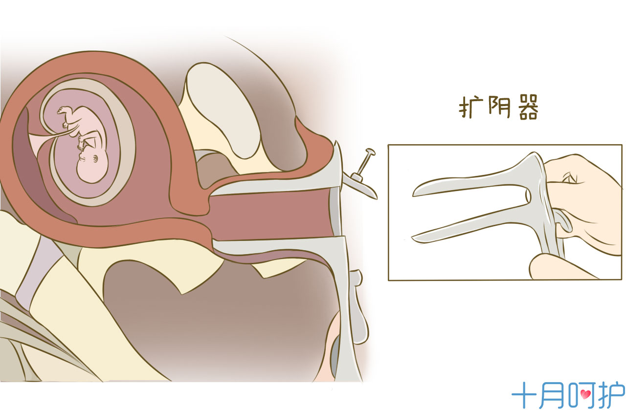 胎儿钳夹术过程图图片