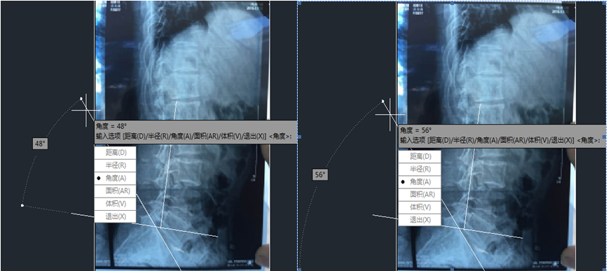 如图腰骶角48度,ss为56度.都属于严重偏大,大于45度.