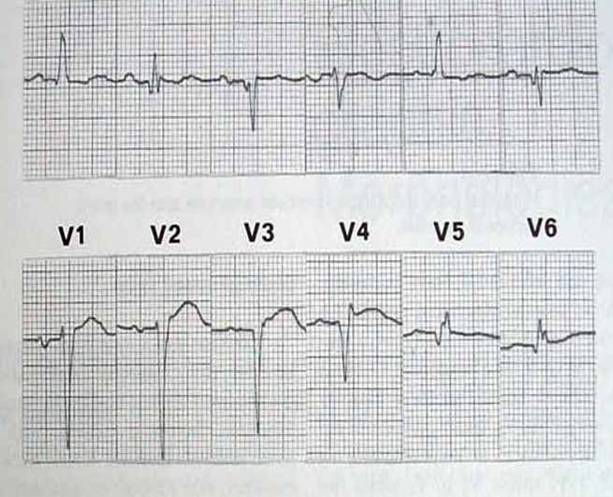室壁瘤心电图表现图片