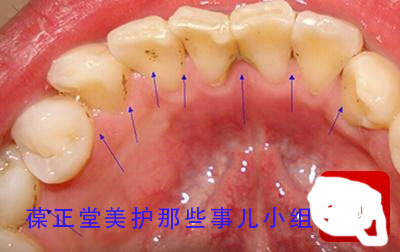 去除牙垢简单易行小窍门