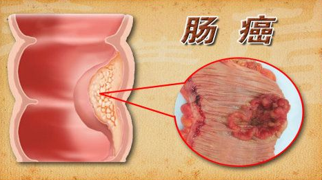 要点改善高血脂人体在正常饮食下