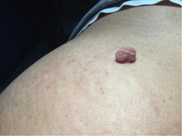 女性屁股上的脂肪瘤图片