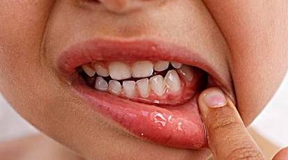 宝宝嘴巴长红泡,是手足口病还是疱疹性口腔炎?