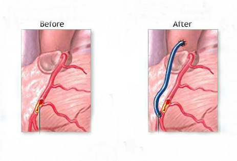 心脏支架手术过程图解图片