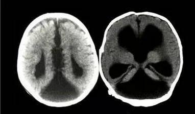 愚昧父母坚持宝宝大脑袋才聪明,可怜1岁孩子没了