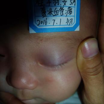 宝宝眼皮变紫泡,原来是血管瘤