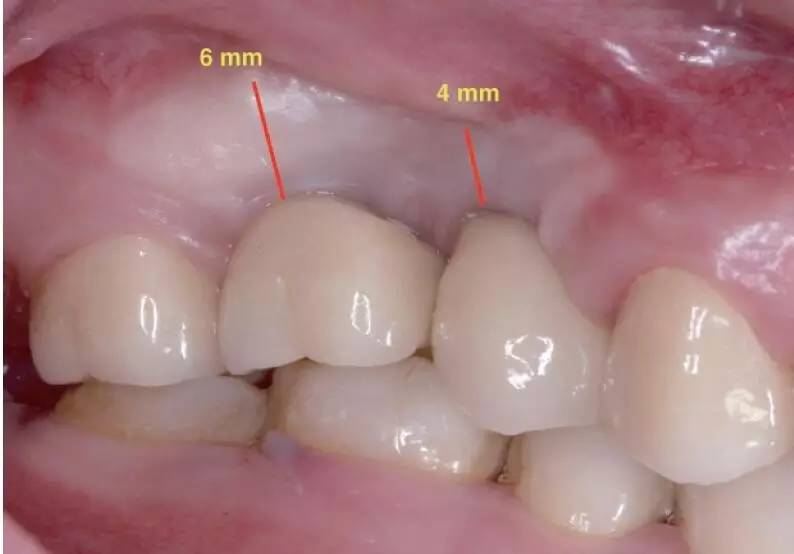 永久修复结语在口腔种植学科中上颌后牙区主要是指上颌第二前磨牙至第