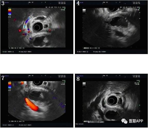 胰腺癌彩超图片