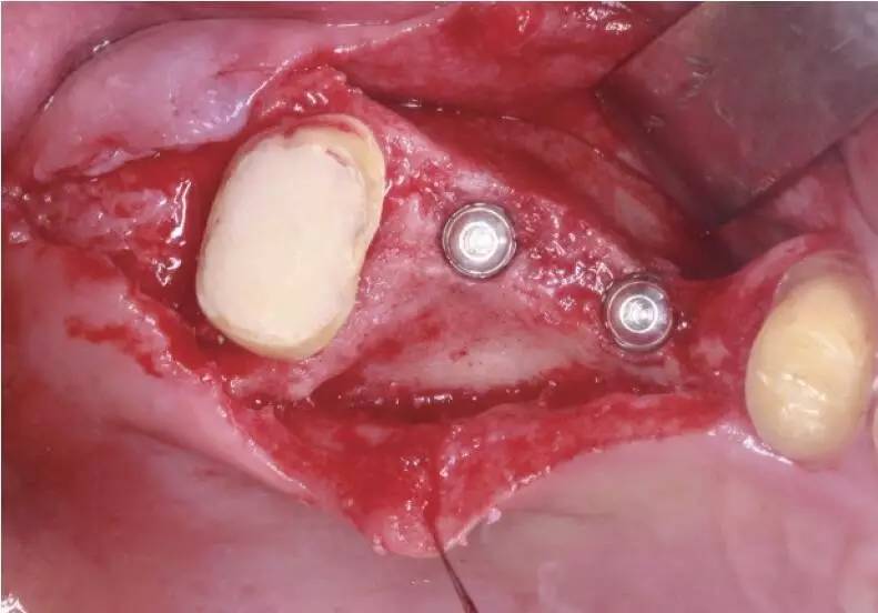 病例展示上颌后牙区种植难点及解决方案楚德国医师