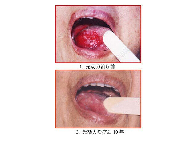 舌癌治疗方法图片