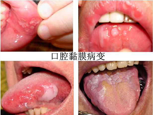 在患上口腔粘膜炎后,嘴里会有粗涩,灼烧感,痛性溃疡等症状
