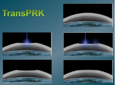 transprk是冷激光,激光介质为氟化氩(arf,波长193nm,发出的光子可为