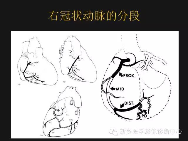 冠狀動脈解剖精細到每一個分支