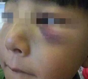 震惊!河南郑州一男童幼儿园鼻子磕骨折,幼儿园:等十几年后再来找