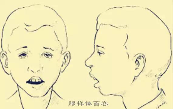 孩子腺樣體肥大_孩子腺樣體肥大影響