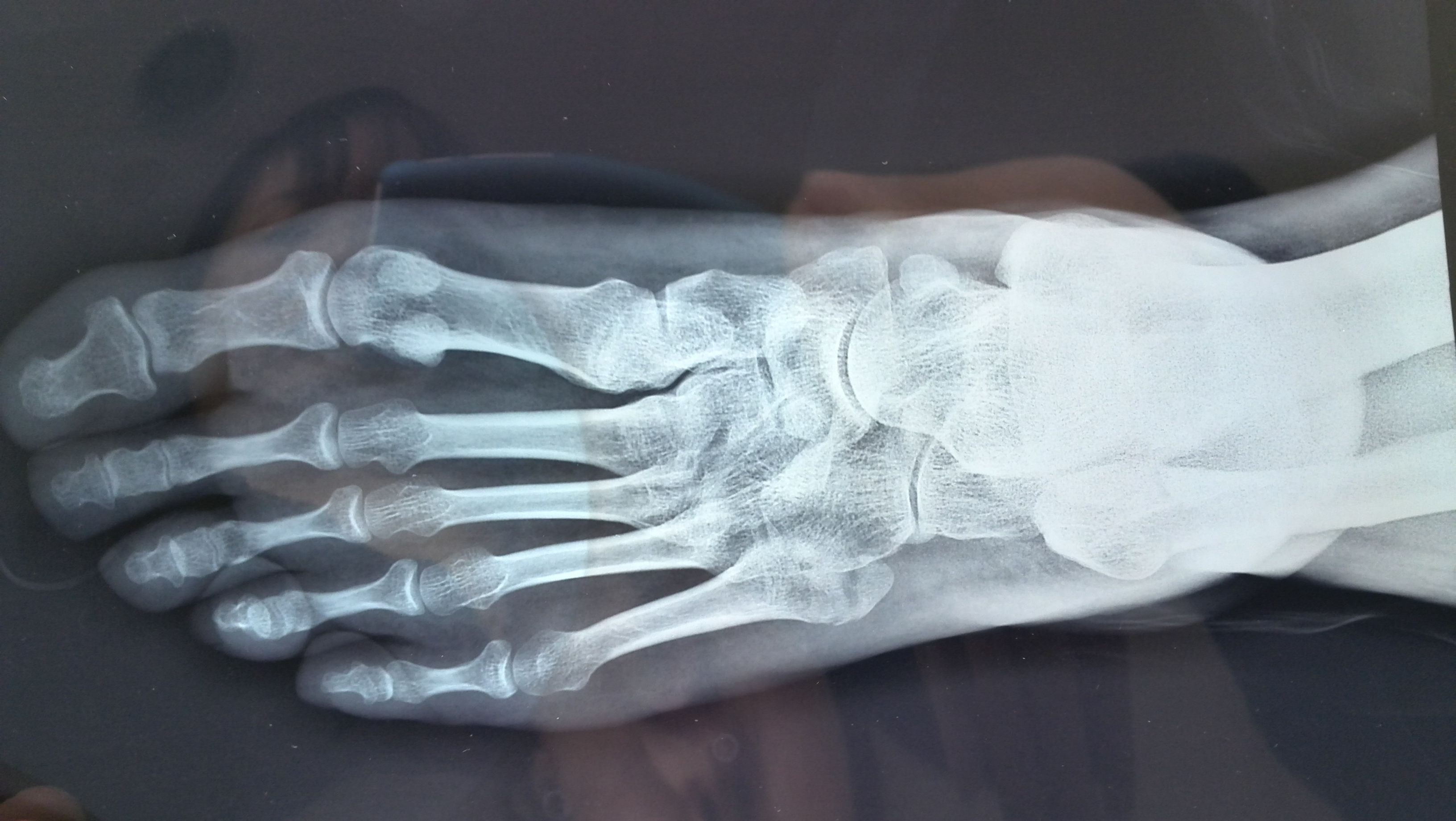 脚骨裂的x光图片图片