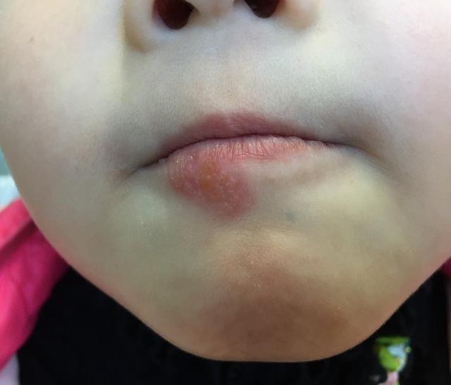 最后提醒的是,如果自己口唇有疱疹,千万不要亲吻孩子,不管孩子是不是