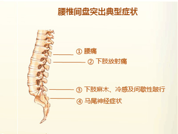 分享腰椎间盘突出科学治疗的好方法