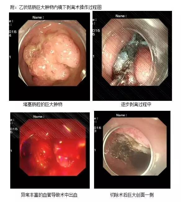 因连续血便发现巨大结肠早期癌,一周顺利出院因为它?