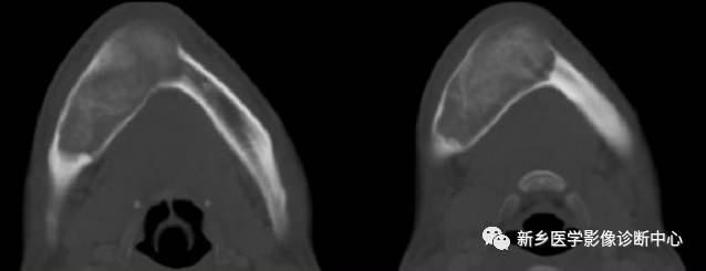肋骨骨化性纤维瘤图片