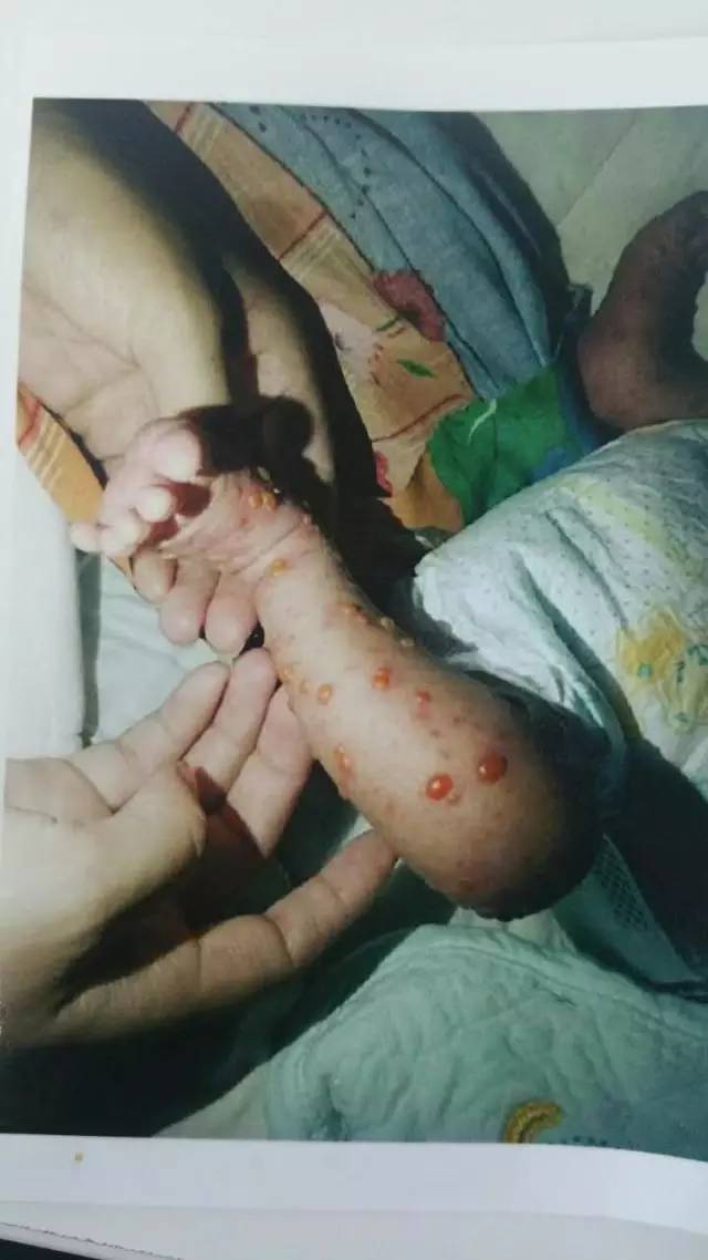 新生儿脓疱疮图片图片