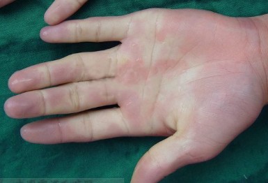 冬天手指经常发白变紫,小心免疫系统疾病上身